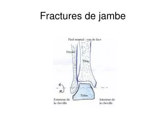 Ppt Fractures De La Diaphyse Femorale Powerpoint Presentation Free