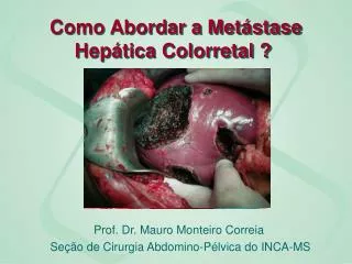 como abordar a met stase hep tica colorretal