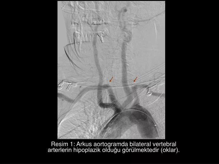resim 1 arkus aortogramda bilateral vertebral arterlerin hipoplazik oldu u g r lmektedir oklar