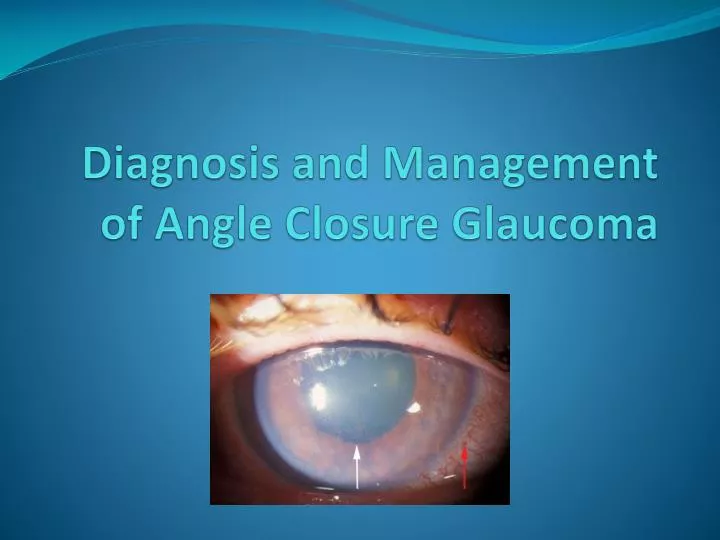 diagnosis and management of angle closure glaucoma