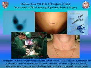 Miljenko Bura MD, PhD, KBC Zagreb, Croatia Department of Otorinolaryngology Head &amp; Neck Surgery