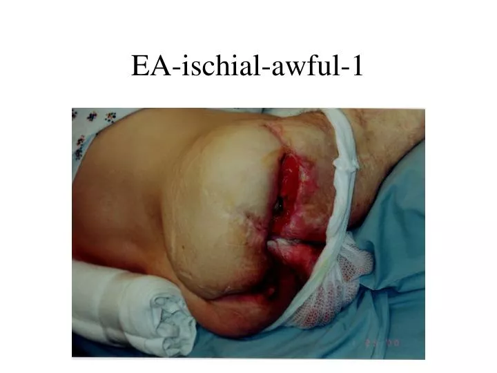 ea ischial awful 1