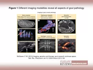 Figure 1 Different imaging modalities reveal all aspects of gout pathology