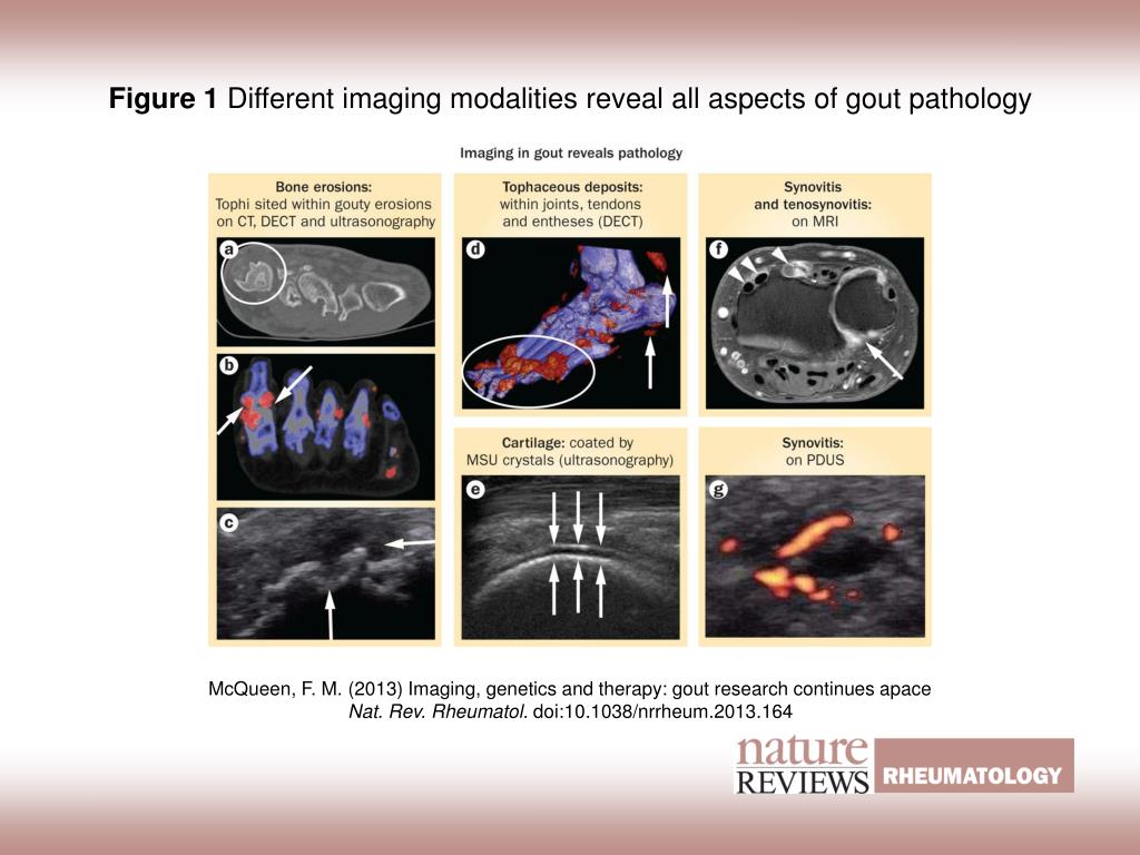 PPT - Figure 1 Different imaging modalities reveal all aspects of gout ...
