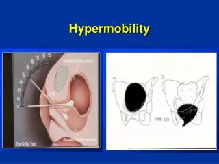 hypermobility