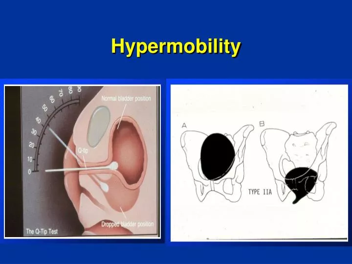 hypermobility