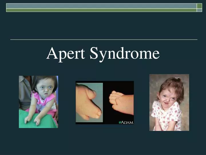 apert syndrome newborn