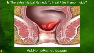 Is There Any Herbal Remedy To Heal Piles Hemorrhoids?