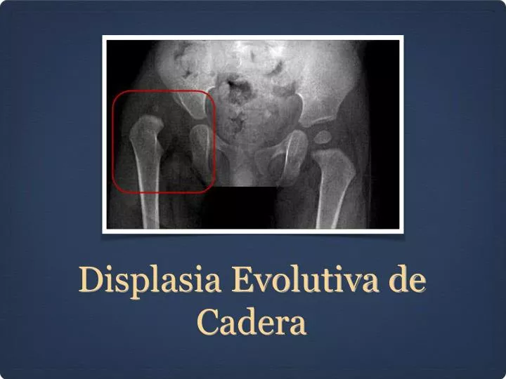 displasia evolutiva de cadera
