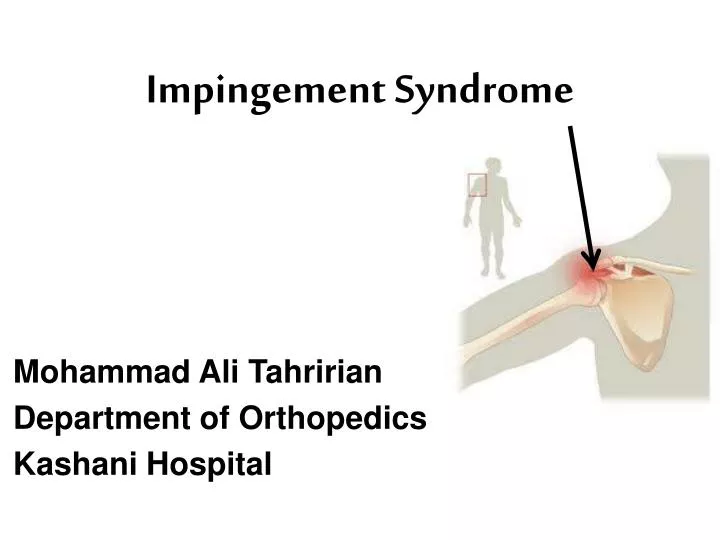 impingement syndrome