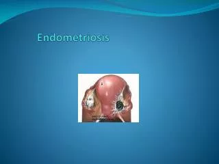 Presence of endometrial tissue (glands &amp; stroma ) outside the uterus