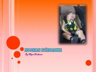 Noonan Syndrome