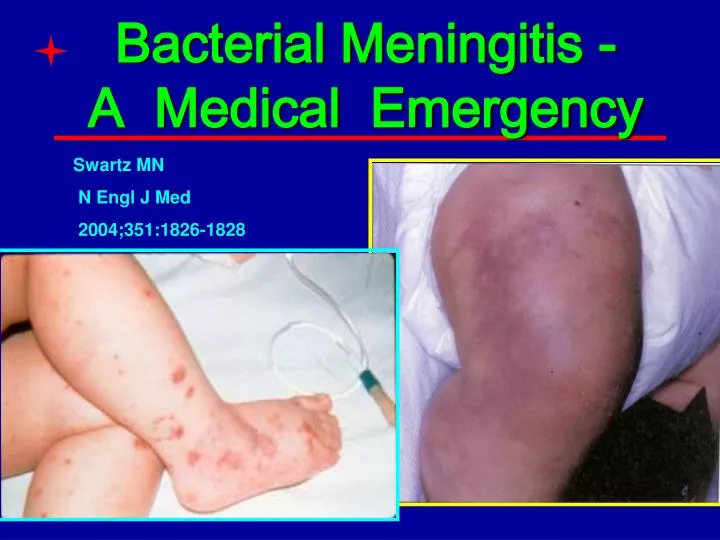 bacterial meningitis a medical emergency