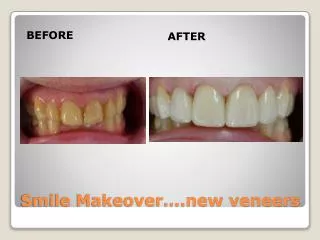 Smile Makeover….new veneers