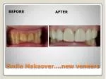 Smile Makeover….new veneers - slide 1
