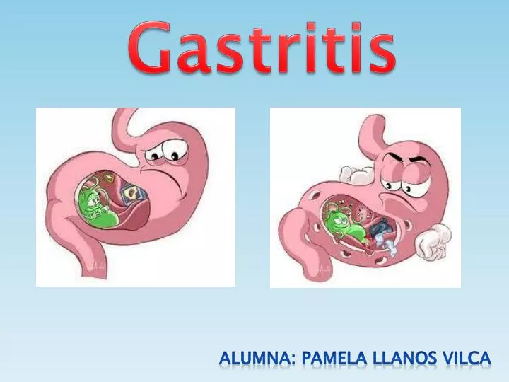 gastritis