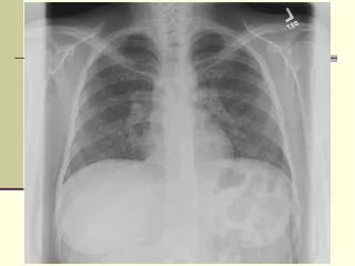 Histoplasmosis