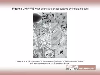 Figure 5 UHMWPE wear debris are phagocytosed by infiltrating cells