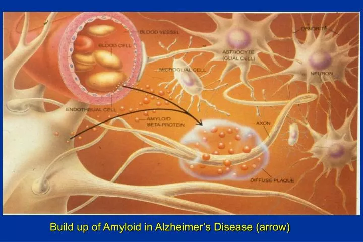 build up of amyloid in alzheimer s disease arrow