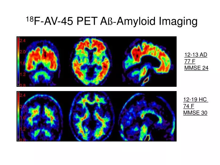 18 f av 45 pet a amyloid imaging