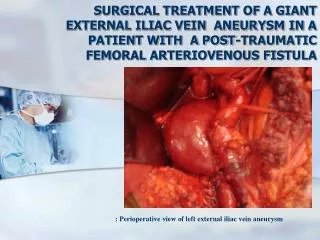 : Perioperative view of left external iliac vein aneurysm