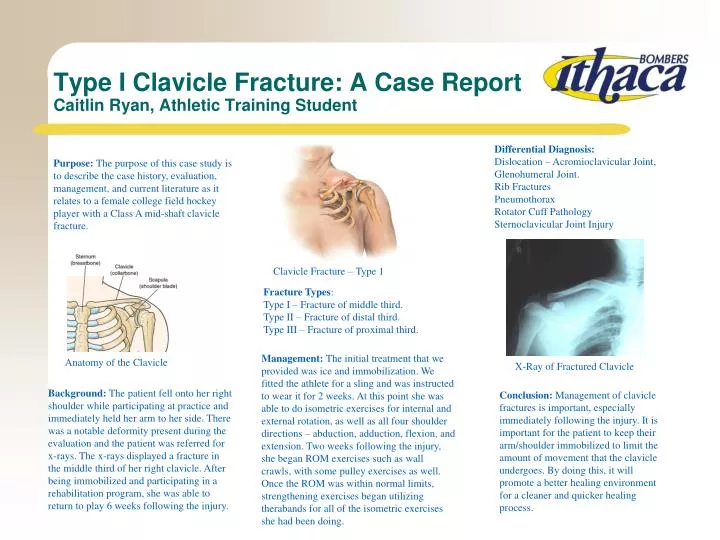 type i clavicle fracture a case report caitlin ryan athletic training student