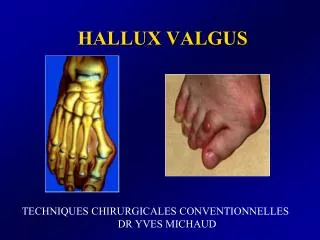 hallux valgus