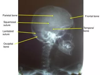 Parietal bone