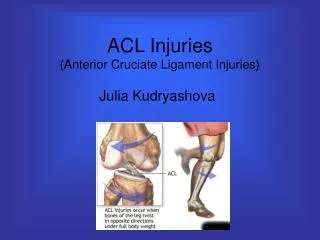 ACL Injuries (Anterior Cruciate Ligament Injuries)