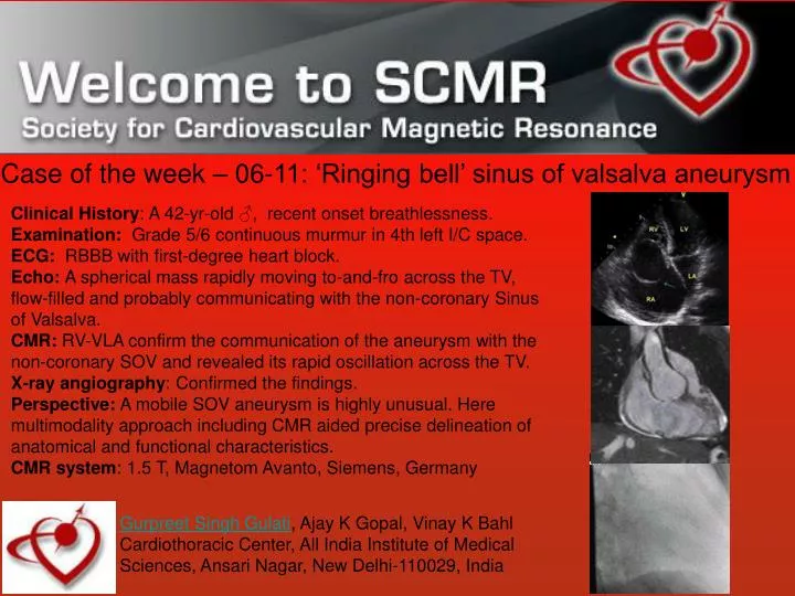 case of the week 06 11 ringing bell sinus of valsalva aneurysm