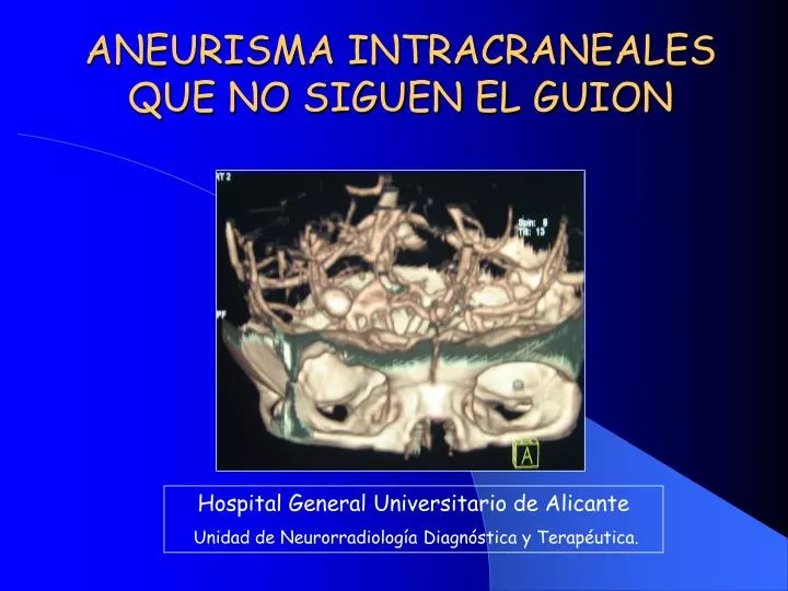 aneurisma intracraneales que no siguen el guion