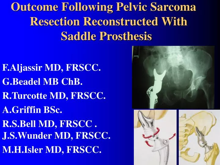 outcome following pelvic sarcoma resection reconstructed with saddle prosthesis