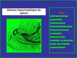 Sténose hypertrophique du pylore