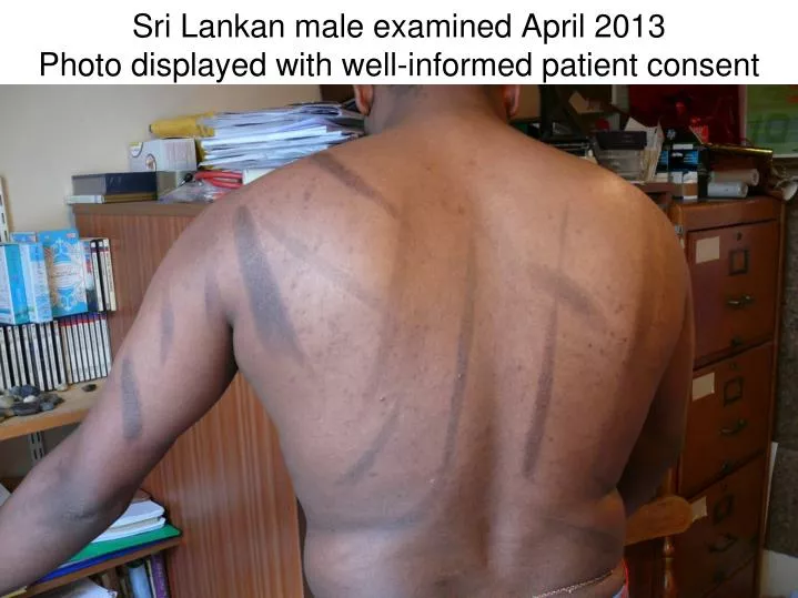 sri lankan male examined april 2013 photo displayed with well informed patient consent
