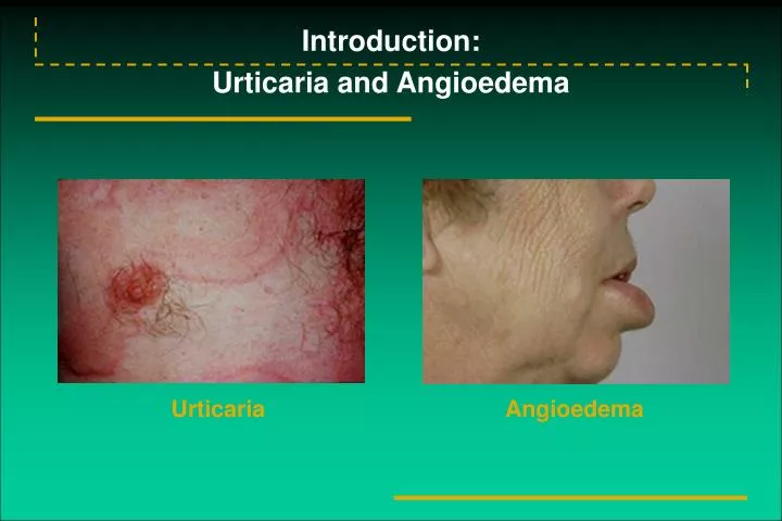 introduction urticaria and angioedema