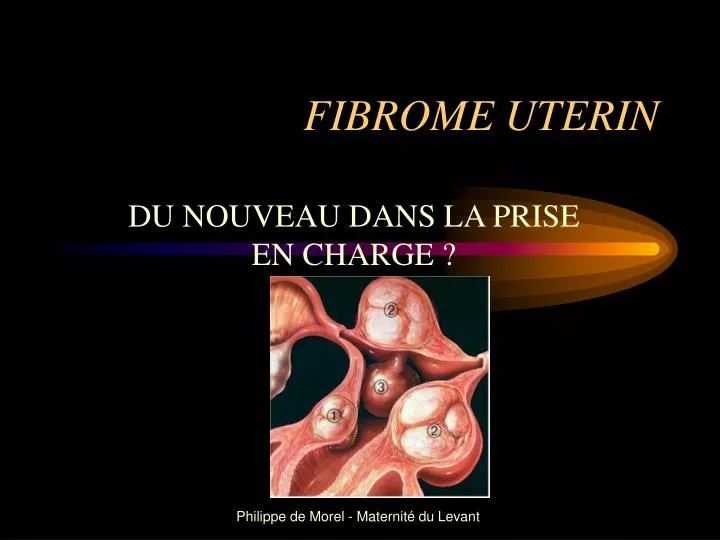 fibrome uterin