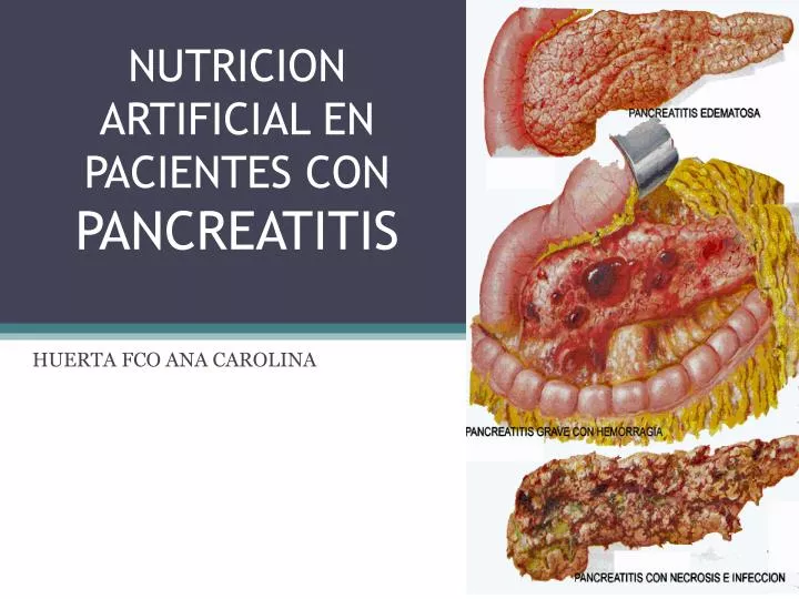 nutricion artificial en pacientes con pancreatitis