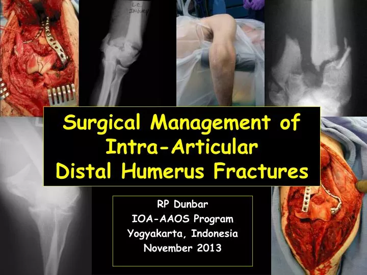 surgical management of intra articular distal humerus fractures