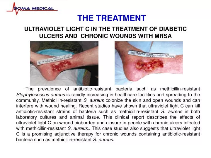 ultraviolet light c in the treatment of diabetic ulcers and chronic wounds with mrsa