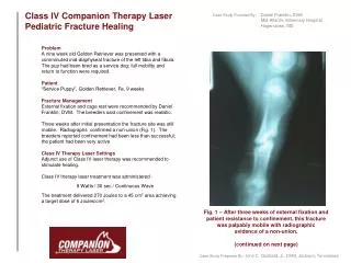 Class IV Companion Therapy Laser Pediatric Fracture Healing