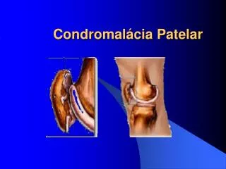 condromal cia patelar