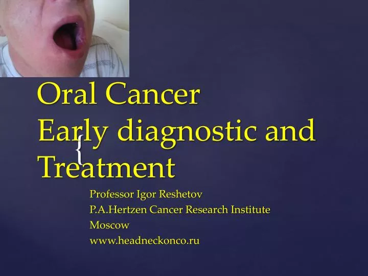 oral cancer early diagnostic and treatment