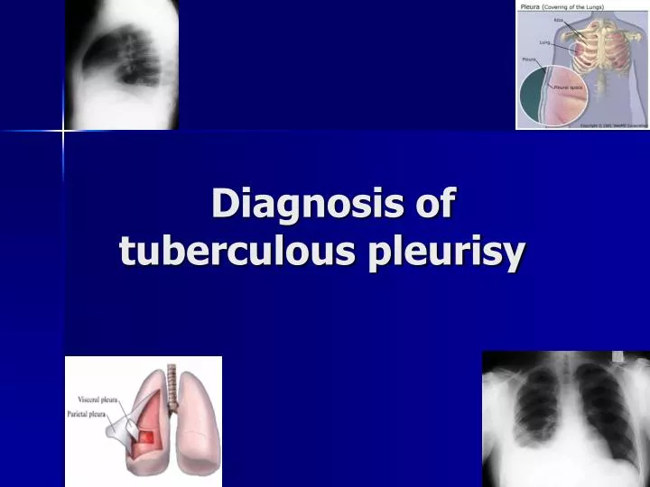 diagnosis of tuberculous pleurisy