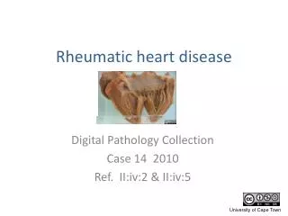 Rheumatic heart disease