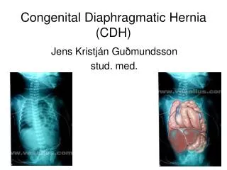 congenital diaphragmatic hernia cdh