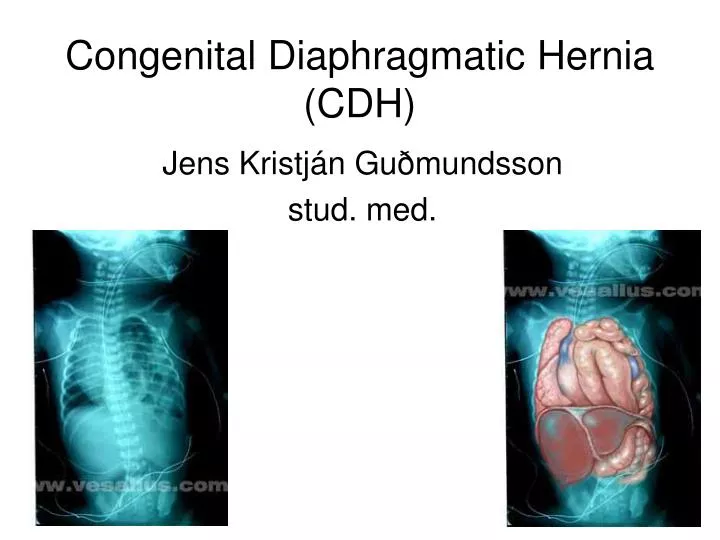 congenital diaphragmatic hernia cdh