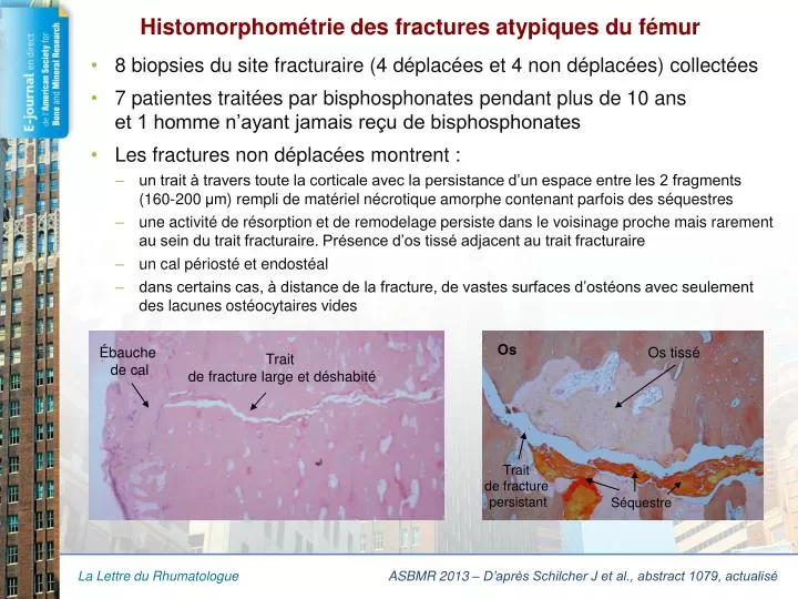 histomorphom trie des fractures atypiques du f mur