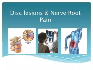 Disc lesions &amp; Nerve Root Pain