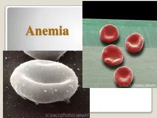 Anemia