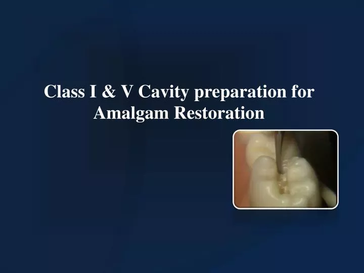 class i v cavity preparation for amalgam restoration